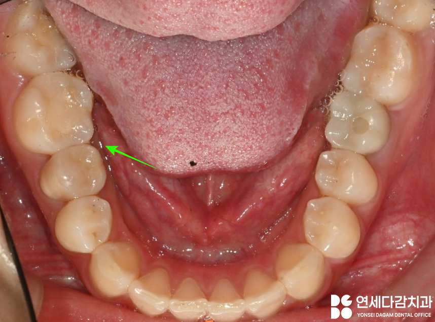 매복과잉치 를 발치할 때 CT 촬영이 필요한 이유? 연세다감치과 의학 정보 전달 글 관련 이미지 9