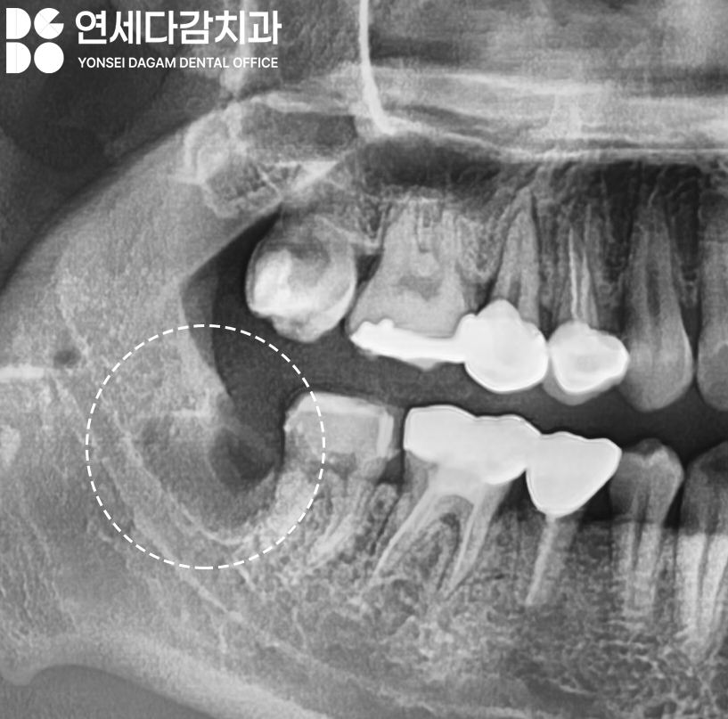복잡한 매복 사랑니 발치 오금동 치과 에서 CT 촬영을 통한 분석 과정 관련 이미지 8