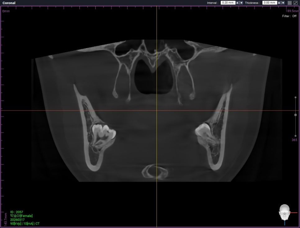 Garak-dong Wisdom Tooth Extraction: What If Two Wisdom Teeth Grew Fused Together? [A Case of Fused Wisdom Tooth Extraction] image 4