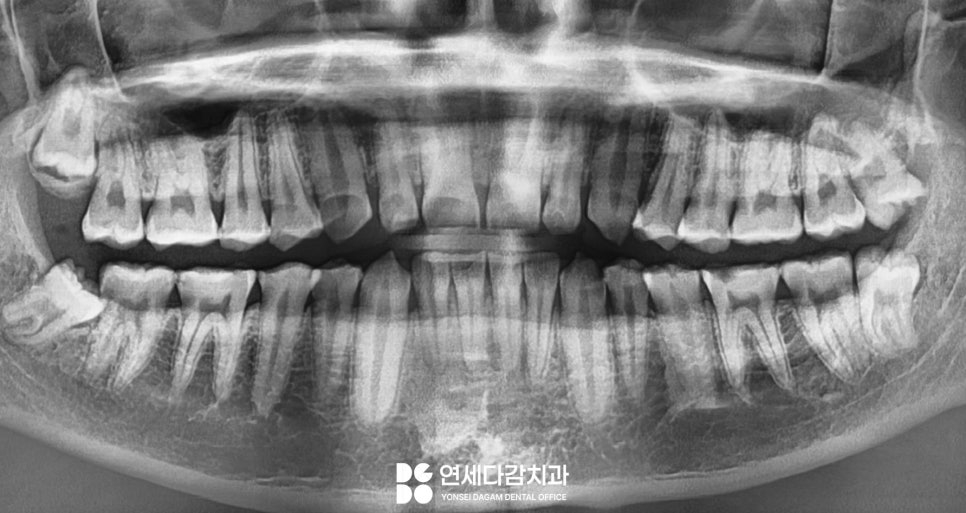 마모로 인한 치아 교모증 문정동 치과 에서 원인과 크라운 치료 방법 알려드리겠습니다. 관련 이미지 6
