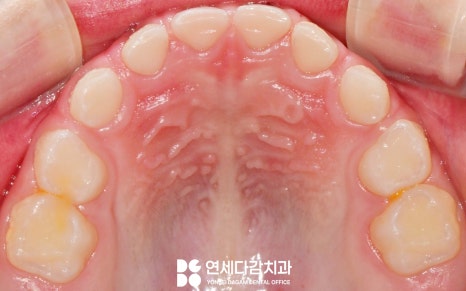 아이가 앞으로 넘어졌을 때 앞니 치료 확인법 거여역 치과 소아 치아 외상의 이해와 관리 관련 이미지 2