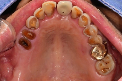 Munjung-dong Dentist: What Does Tooth Attrition Mean, What Are Its Symptoms, and How Is It Treated? image 3
