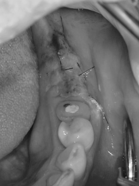 Munjeong-dong Dental Clinic, Bone Graft Implant Process&middot; What If You’ve Lost a Molar? image 6