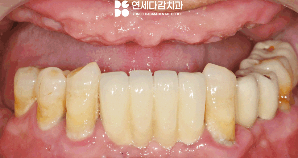 불편한 틀니 임플란트로 바꿔 치료할 수 있을지 가락시장역 치과 에서 살펴봅시다. 관련 이미지 11