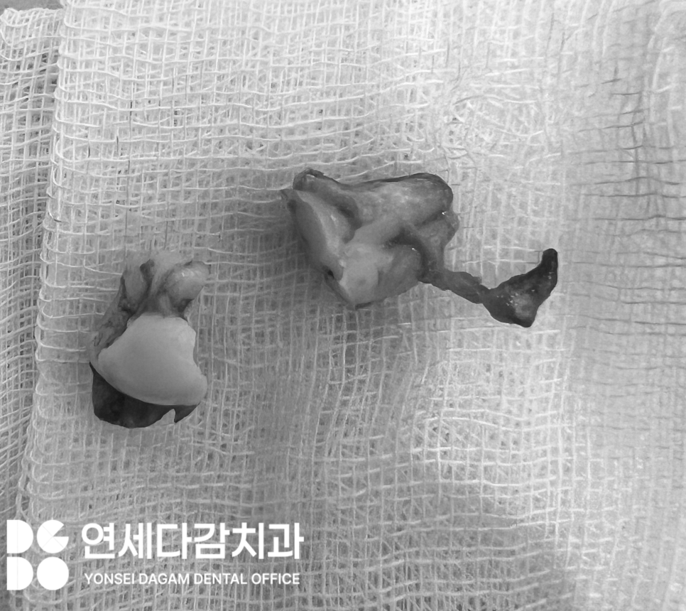 복잡한 매복 사랑니 발치 오금동 치과 에서 CT 촬영을 통한 분석 과정 관련 이미지 4