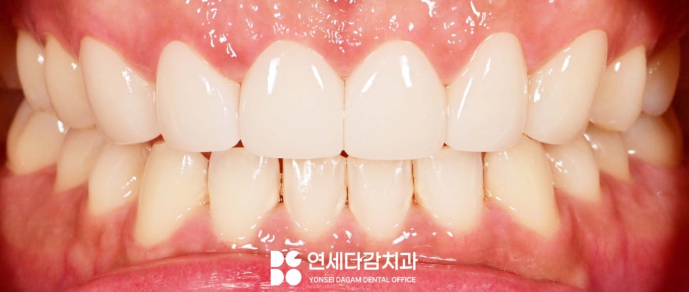 연세다감치과 심미 치료 무삭제 라미네이트 통해 자신감 있는 미소를 되찾는 여정 관련 이미지 7