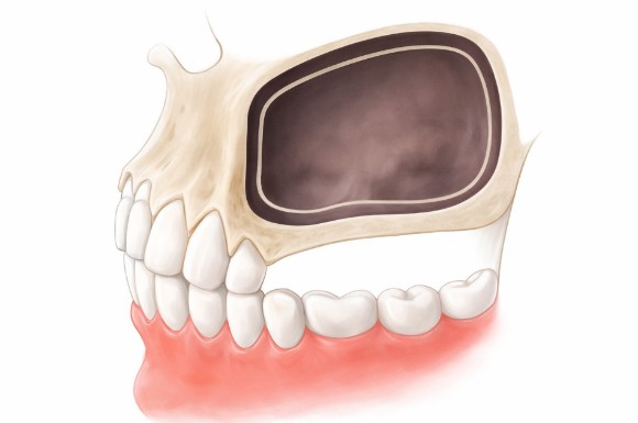 Why a Sinus Lift May Be Needed When There Is Insufficient Bone for Implants in Munjeong-dong image 1