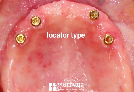 거여동 치과 임플란트 틀니 깨졌을 때 오버덴처 overdenture 종류 및 수리 기간 관련 이미지 4