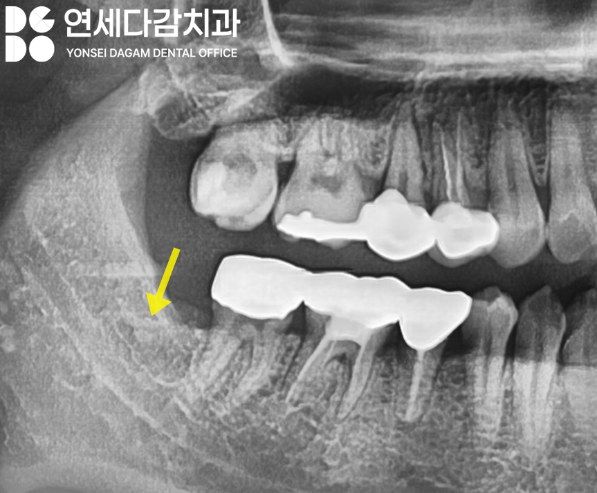 복잡한 매복 사랑니 발치 오금동 치과 에서 CT 촬영을 통한 분석 과정 관련 이미지 9