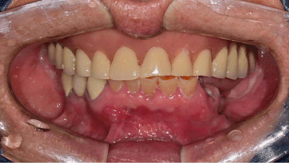 Seokchon-dong Dental Clinic, 연세다감치과: Why You Should Carefully Review the Denture-Making Steps · Process from the Beginning image 7