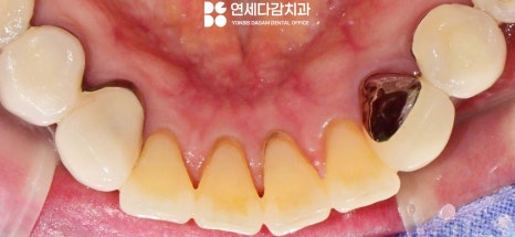 앞니 레진 후 생긴 변색 문제와 삐뚤어진 치아 개롱역 치과 최소삭제 라미네이트 적용할 수 있는 이유 관련 이미지 3