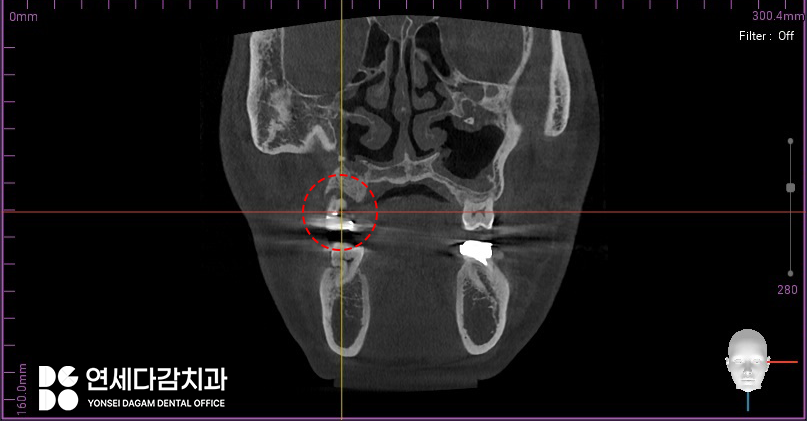 축농증 수술 후에도 임플란트 수술 가능할까? 특별한 송파구 치과 케이스의 해결책 관련 이미지 3