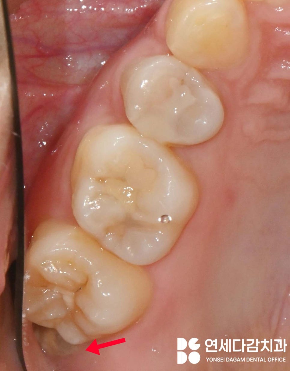 기울어진 매복 사랑니 발치 더 주의깊게 봐야 되는 이유 개롱역 치과 에서 살펴봅시다. 관련 이미지 1
