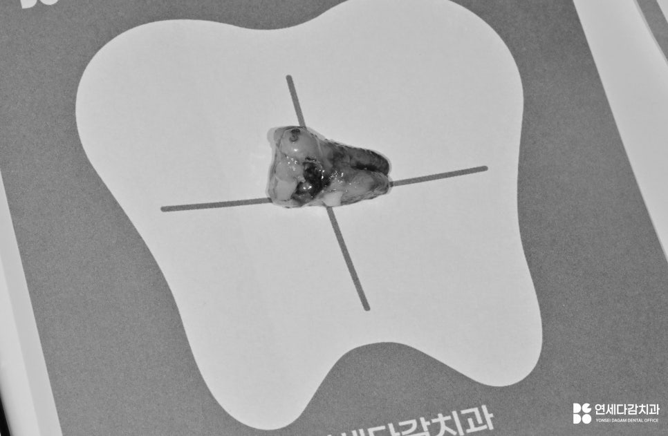 개롱역치과 아프기 전에 발견해야 되는 이유 인접면 충치 치료 관련 이미지 4