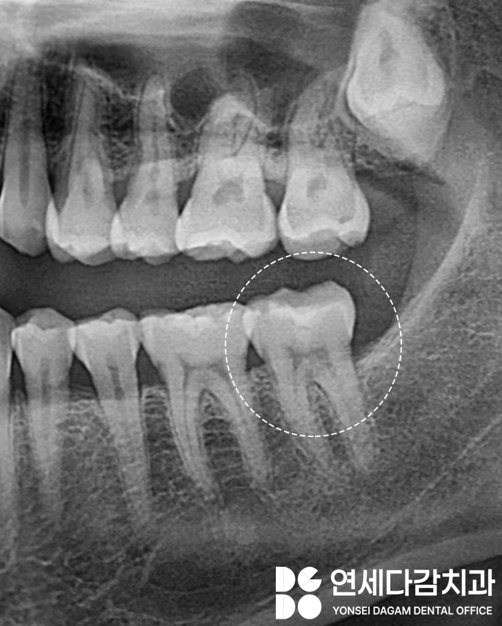 어금니 깨짐, 치아에 금 갔을 때 찌릿한 통증 가락시장역 치과 신경치료 후 크라운 꼭 씌워야 되는 이유와 예방법 관련 이미지 3