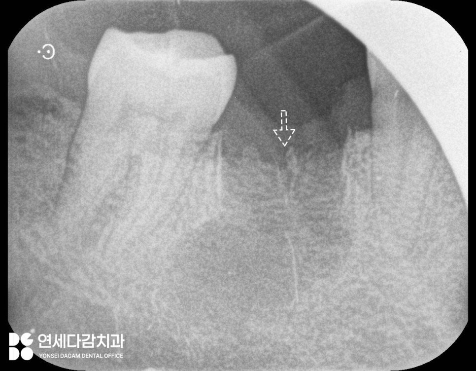 신경치료 후 크라운 떨어짐 원인으로 감염된 충치 치료 미루다 잇몸뼈 녹음 증상 개롱역 치과 발치 후 치근단 낭 적출술 관련 이미지 7