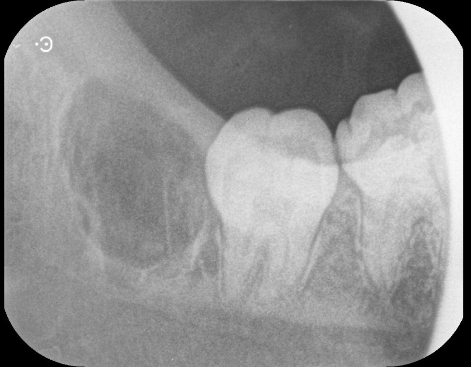 Garak-dong Wisdom Tooth Extraction: What If Two Wisdom Teeth Grew Fused Together? [A Case of Fused Wisdom Tooth Extraction] image 9