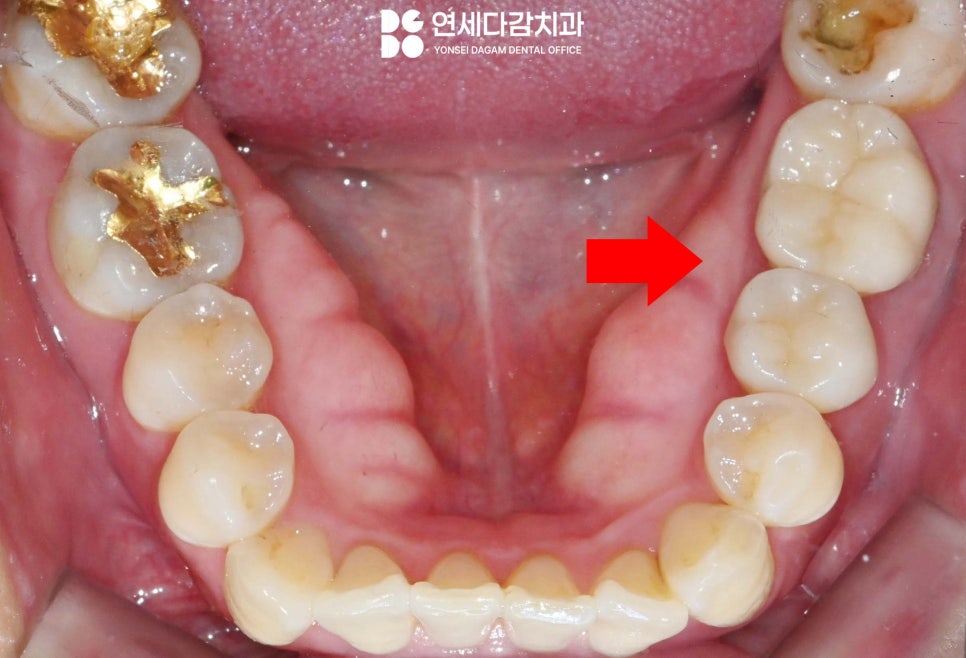 턱뼈에 발생하는 법랑모세포종 거여동 치과 에서 원인과 치료 방법 알려드리겠습니다. 관련 이미지 2