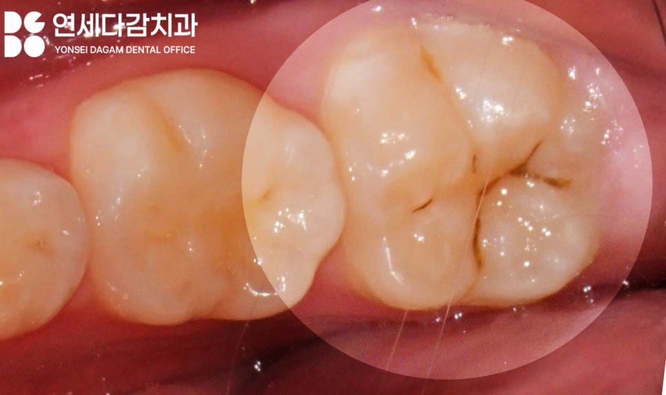오금동 치과 충치 레진 치료 보험 혜택받을 수 있을까 우리 아이 구강 건강을 위한 치아 우식 예방법 관련 이미지 3