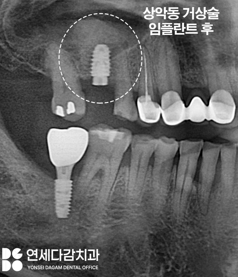 잇몸뼈 없으면 임플란트 수술 못할까? 오금역 연세다감 치과 상악동 거상술 뼈이식 필요한 경우 관련 이미지 6