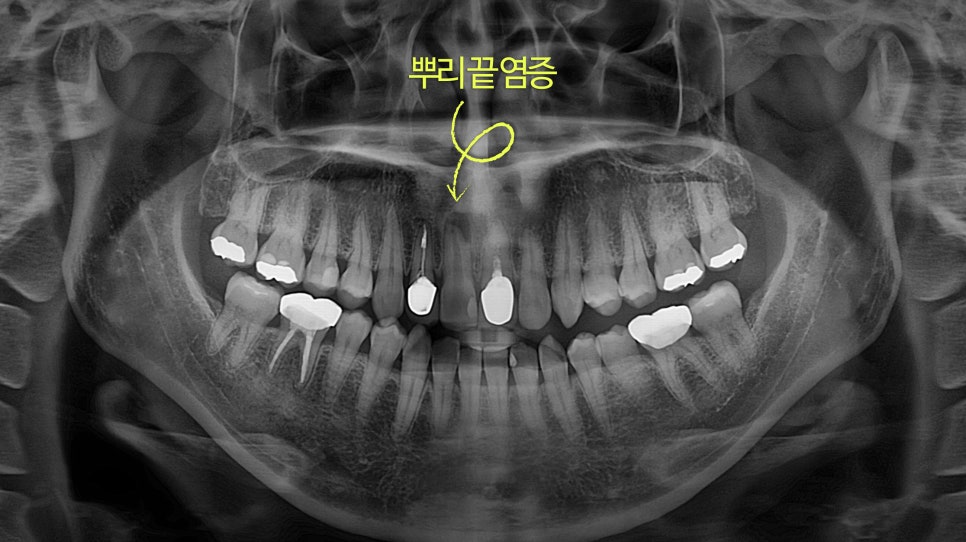 Macheon-dong Dental Clinic: Why Treating Root Inflammation Comes First Before an Anterior Crown image 2