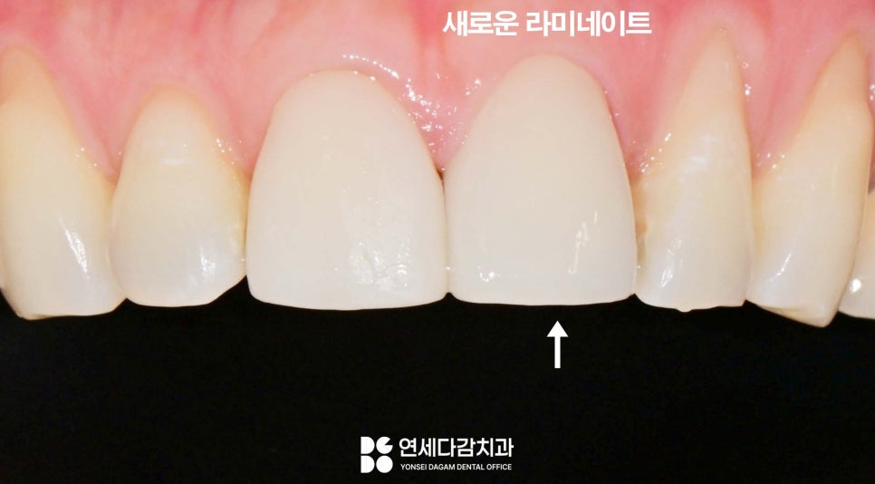 과거와 다르게 앞니 무삭제 라미네이트 가능한 이유 거여역 치과 앞니 보철 깨짐 추가 삭제 없이 재제작 관련 이미지 4