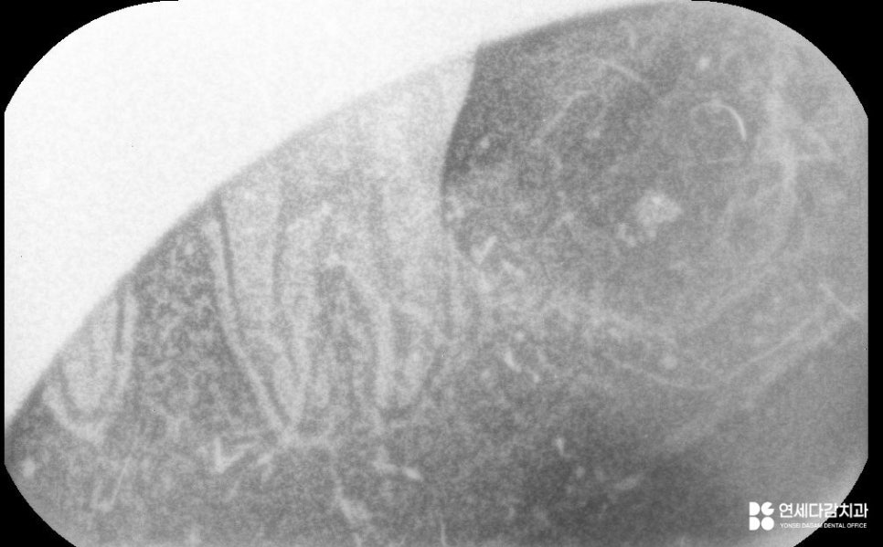 가락동 치과 교정 치료 전 사랑니 발치 꼭 필요할까? - 미성숙 매복케이스로 알아보는 과정 관련 이미지 9