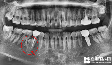 매복과잉치 를 발치할 때 CT 촬영이 필요한 이유? 연세다감치과 의학 정보 전달 글 관련 이미지 2