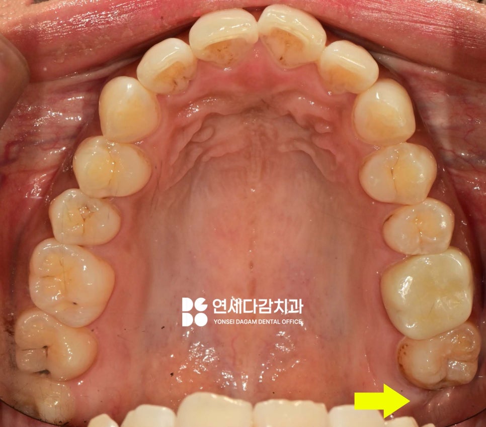 거여역 치과 공포증 수면마취 (의식하진정) 통해 매복 사랑니 발치 및 충치 치료 극복할 수 있습니다. 관련 이미지 5