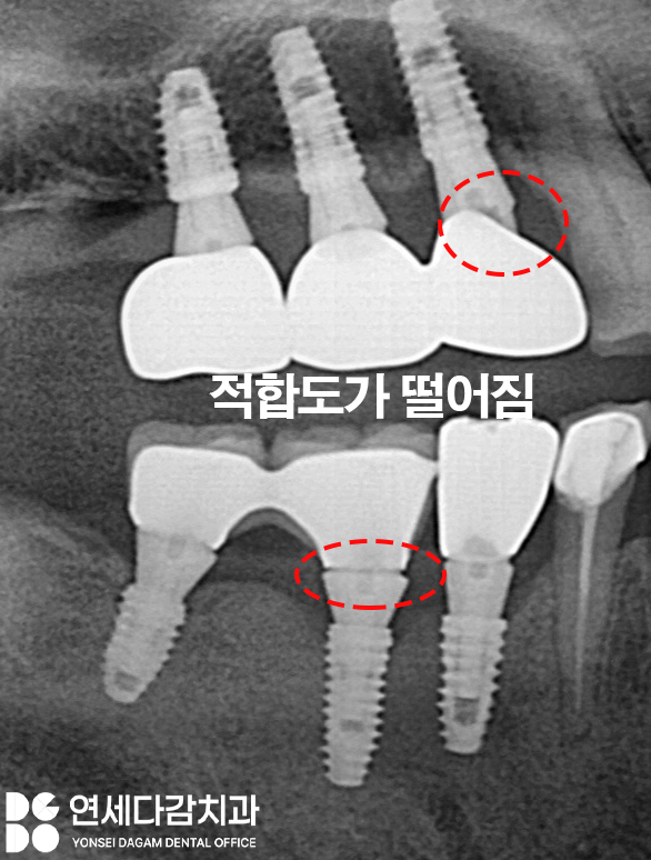 문정역 치과 임플란트 오래 사용하기 위해서 지대주 (어버트먼트) 보철 종류 기성 및 커스텀 지대주 (abutment) 차이 알고 받아야 되는 이유 관련 이미지 7