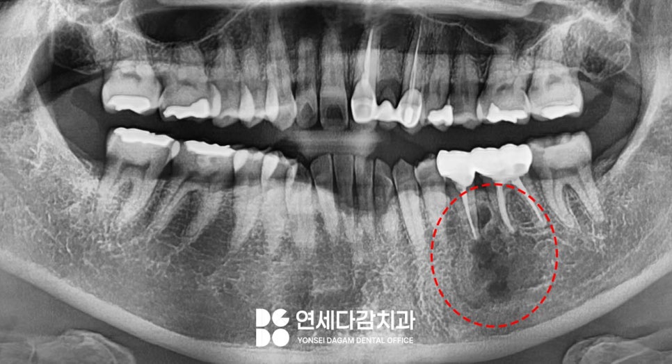 턱뼈에 발생하는 법랑모세포종 거여동 치과 에서 원인과 치료 방법 알려드리겠습니다. 관련 이미지 1