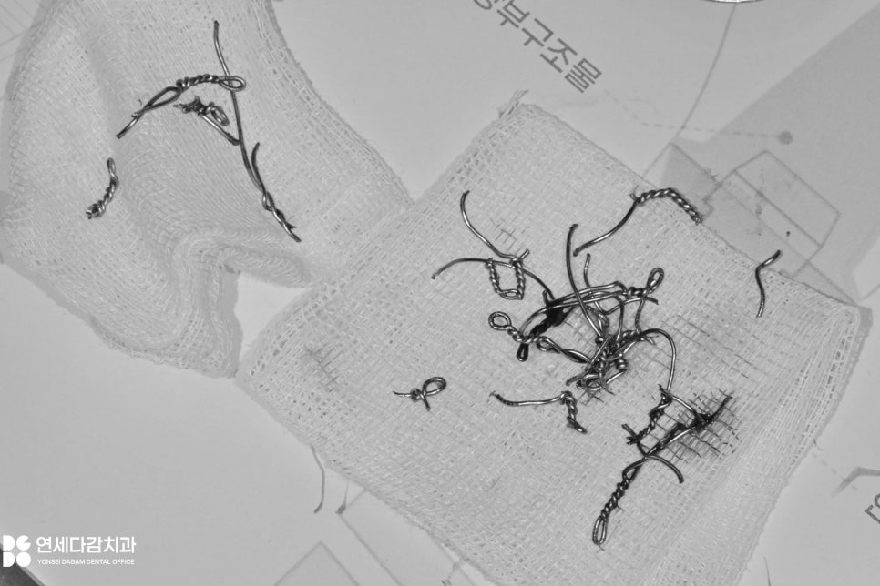 문정역 치과 에서 알아보는 턱뼈 골절 됐을 때 악간고정술 치료 같이 진행하는 이유 관련 이미지 7