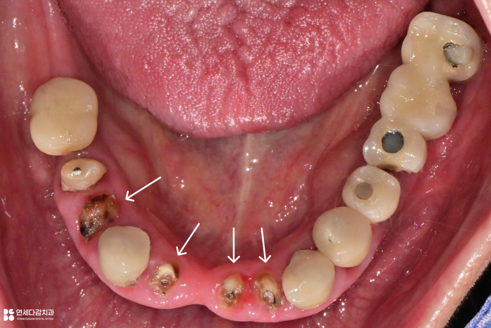 오금역 치과 부분틀니, 예후를 고려한 지대치 평가부터 정밀한 설계까지 중요한 이유 관련 이미지 1