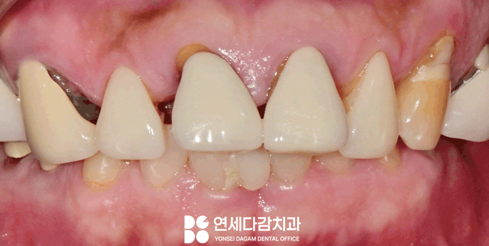 치주염 원인으로 치아 흔들림 오금동 치과 크라운 치료 통해 뻐드러진 앞니 돌출입 해소 과정에서 잇몸치료 필요한 이유 관련 이미지 8