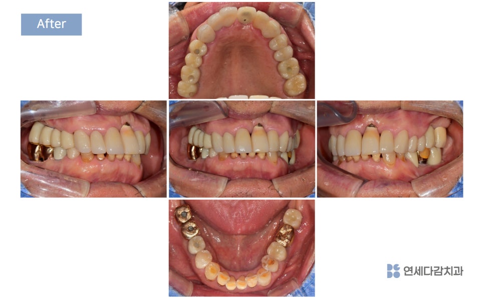 Munjung-dong Dentist: What Does Tooth Attrition Mean, What Are Its Symptoms, and How Is It Treated? image 13