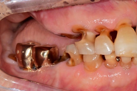 Munjung-dong Dentist: What Does Tooth Attrition Mean, What Are Its Symptoms, and How Is It Treated? image 2