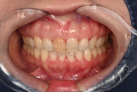 Geoyeo-dong Dental Clinic: Case of Internal Bleaching for a Discolored Front Tooth After Trauma image 1