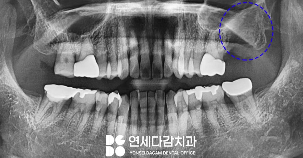 심한 염증으로 특이한 곳에 위치한 매복 사랑니 송파역 치과 에서 임플란트 수술과 함께 안전한 발치 했습니다. (feat. 상악동 천공 폐쇄술 ) 관련 이미지 3