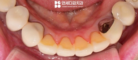 앞니 레진 후 생긴 변색 문제와 삐뚤어진 치아 개롱역 치과 최소삭제 라미네이트 적용할 수 있는 이유 관련 이미지 9