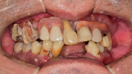 Temporary Teeth After Implants in Songpa-dong: Why They Can Be Provided Quickly image 2