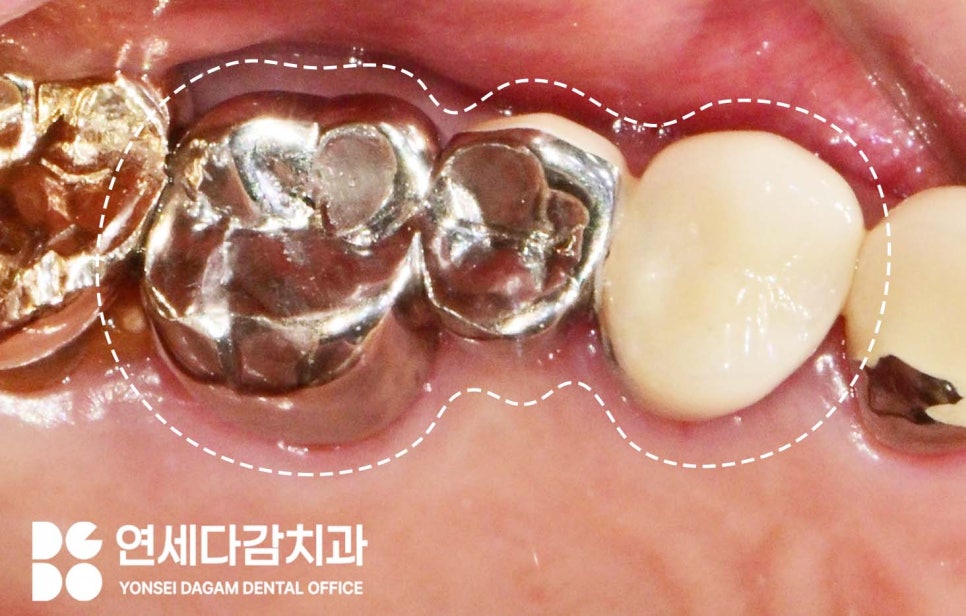 크라운 또는 브릿지 같은 보철 치료 했던 부위에 충치 또는 잇몸질환 생기는 이유 가락시장역 치과 치근우식 생겼을 때 발치 후 임플란트 관련 이미지 2
