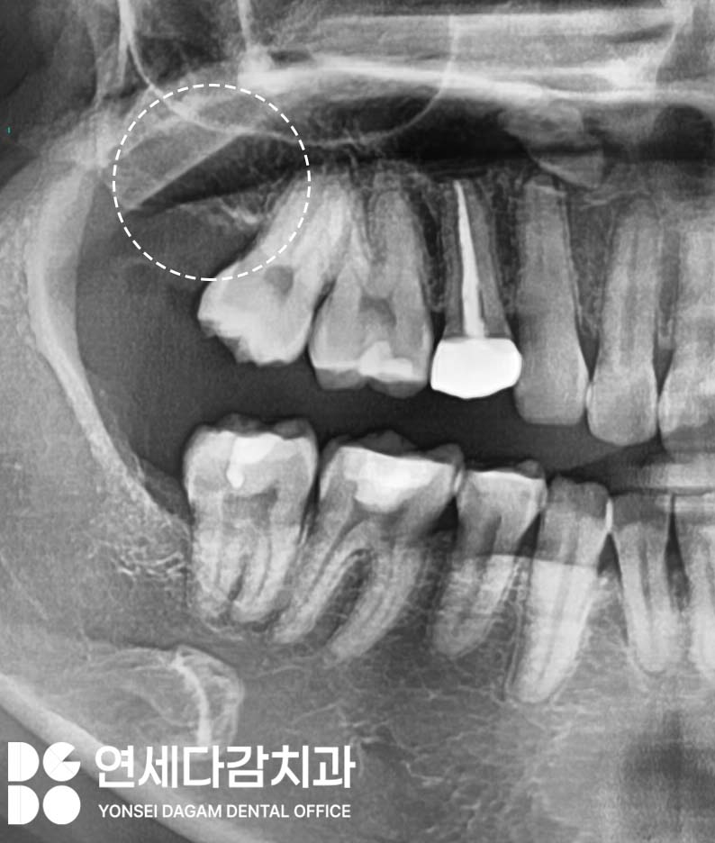 기울어진 매복 사랑니 발치 더 주의깊게 봐야 되는 이유 개롱역 치과 에서 살펴봅시다. 관련 이미지 4