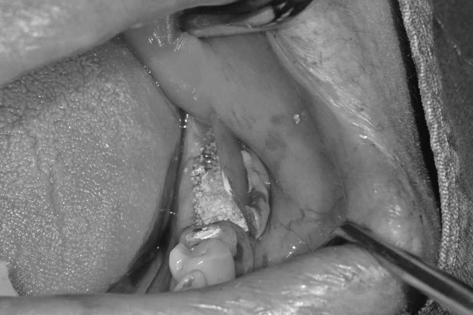 Munjeong-dong Dental Clinic, Bone Graft Implant Process&middot; What If You’ve Lost a Molar? image 4