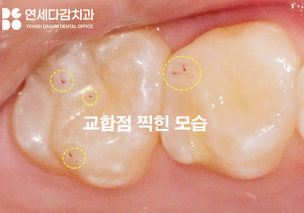 오금동 치과 충치 레진 치료 보험 혜택받을 수 있을까 우리 아이 구강 건강을 위한 치아 우식 예방법 관련 이미지 5