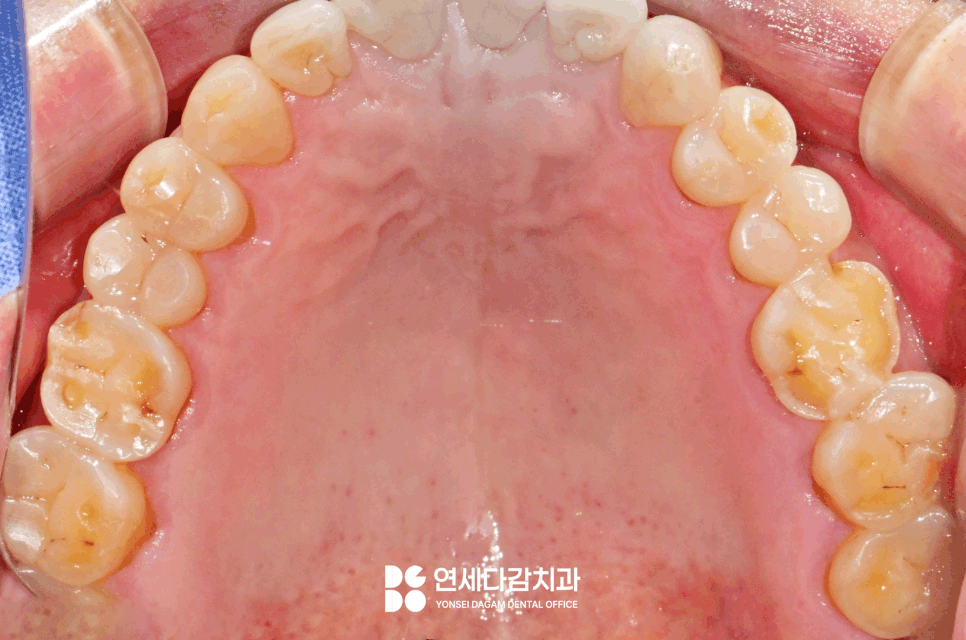 심한 이갈이 원인으로 생기는 치아 마모 및 파절 문제 문정역 치과 교모증 크라운 치료 필요한 이유 관련 이미지 2