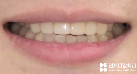 앞니 벌어짐 거여동 치과 치은성형술 동반하여 교정 없이 크라운 교체 및 최소삭제 라미네이트 통한 심미 치료 관련 이미지 8