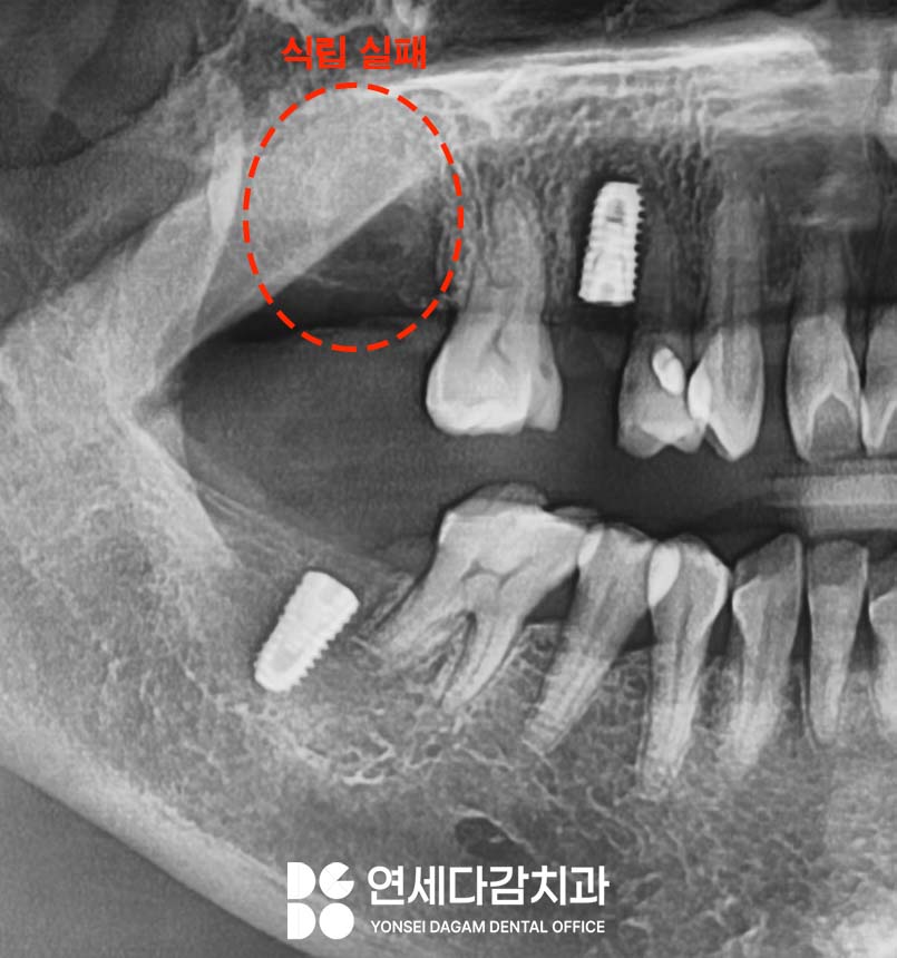 임플란트 재수술 가락동 치과 정밀한 분석과 전략적 접근 통한 치유 과정 관련 이미지 2