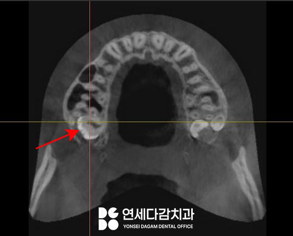 매복 사랑니 옆에 또 다른 치아 이것은 무엇일까요 송파구 가락동 치과 에서 알려드리겠습니다. 관련 이미지 5