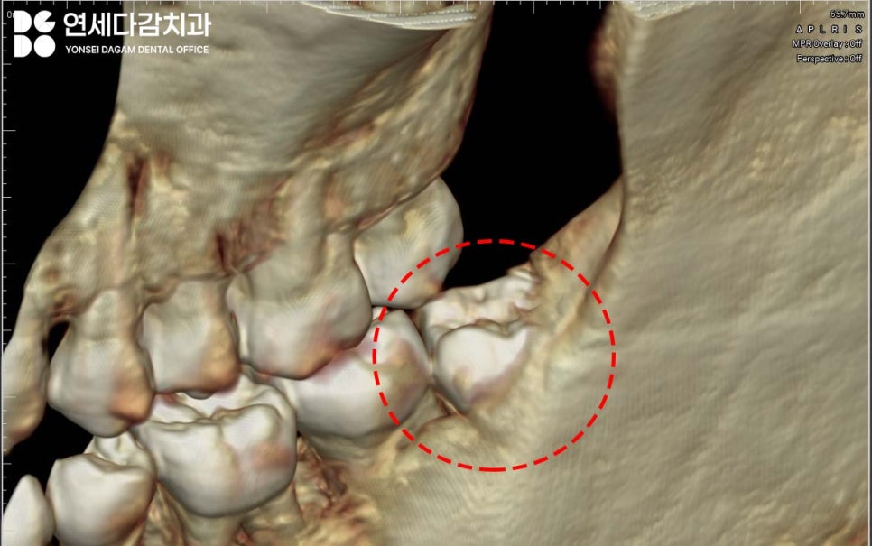 사랑니 부위 잇몸이 붓고 음식물이 자주 껴요 가락동 치과 매복사랑니 발치 후 지혈제 꼭 써야 좋을까? 관련 이미지 4