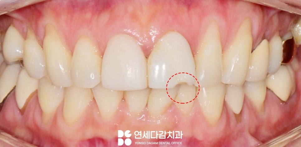 과거와 다르게 앞니 무삭제 라미네이트 가능한 이유 거여역 치과 앞니 보철 깨짐 추가 삭제 없이 재제작 관련 이미지 1